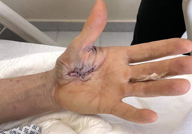 Eric Greager shows the stitches holding together the injuries in his left hand after a vicious crocodile attack while swimming in the ocean in Mexico.